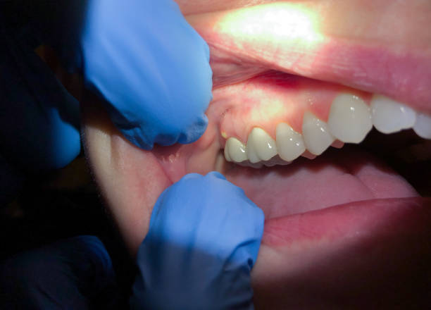 Best Emergency Wisdom Teeth Removal in Springhill, LA